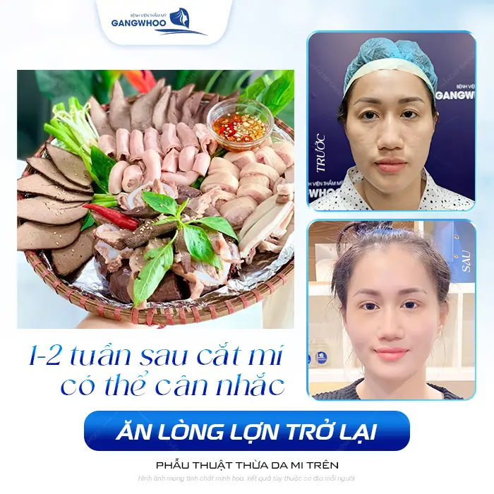 Cắt Mí Mắt Có Ăn Được Lòng Lợn Không? Bác Sĩ Giải Đáp Chi Tiết 3 Cắt Mí Mắt Có Ăn Được Lòng Lợn Không? Bác Sĩ Giải Đáp Chi Tiết