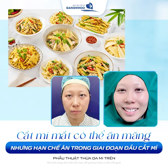 Cắt Mí Mắt Có Ăn Được Măng Không? Phải Kiêng Trong Bao Lâu?
