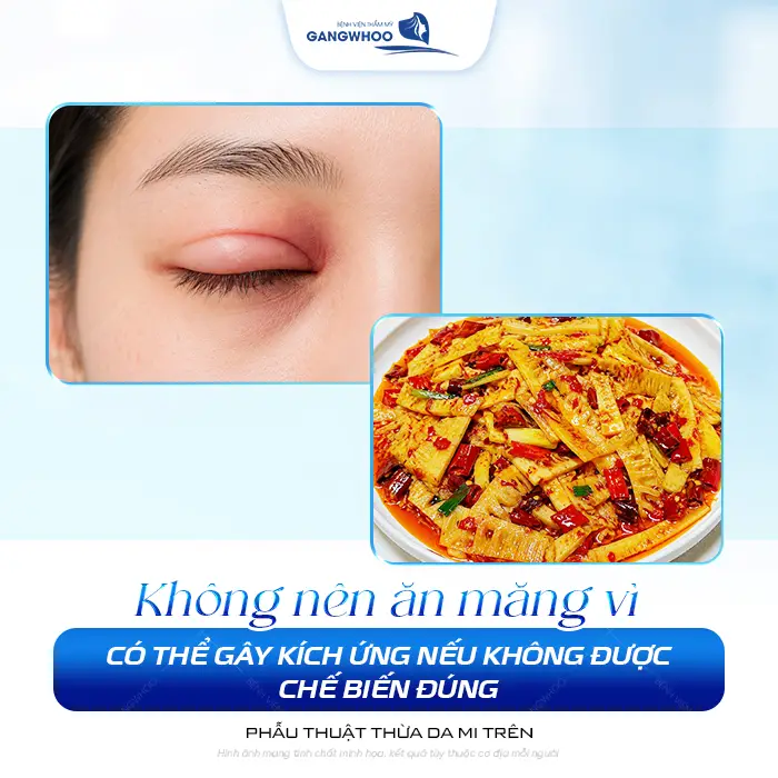 Cắt Mí Mắt Có Ăn Được Măng Không? Phải Kiêng Trong Bao Lâu?