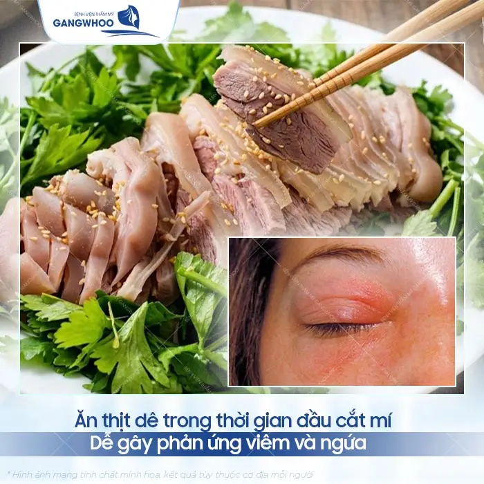 Cắt Mí Mắt Có Ăn Thịt Dê Được Không? Bác Sĩ Giải Đáp Chi Tiết