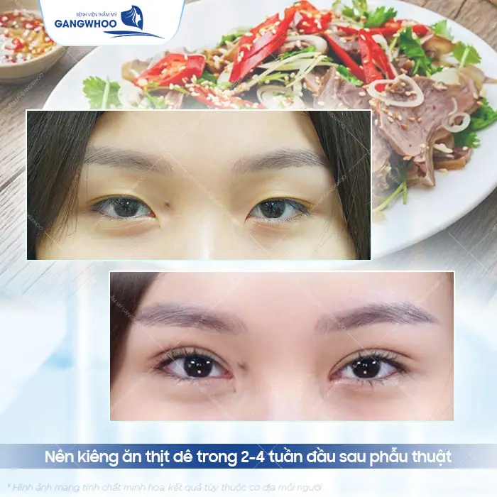 Cắt Mí Mắt Có Ăn Thịt Dê Được Không? Bác Sĩ Giải Đáp Chi Tiết