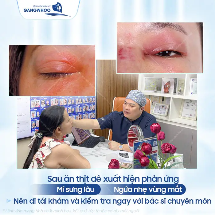 Cắt Mí Mắt Có Ăn Thịt Dê Được Không? Bác Sĩ Giải Đáp Chi Tiết