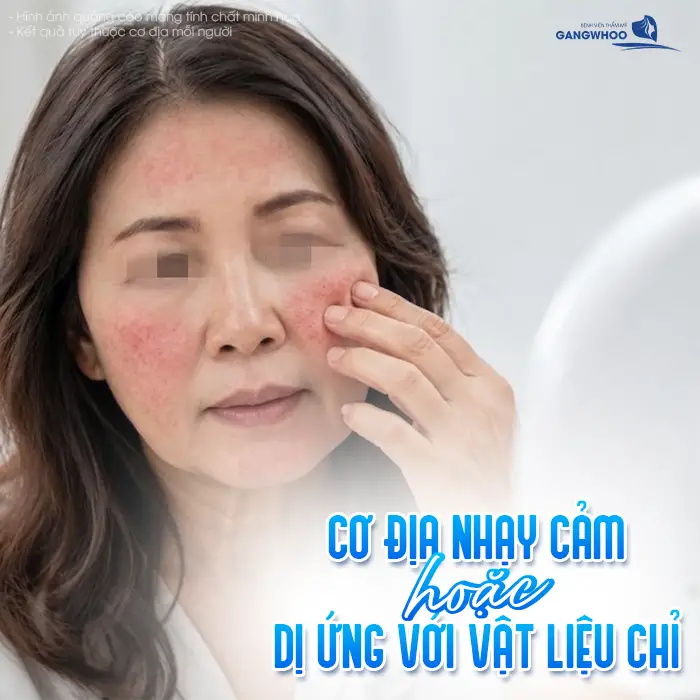 Chỉ Thẩm Mỹ Bị Cộm Ngứa Sau Căng Da Mặt: Nguyên Nhân Và Cách Xử Lý