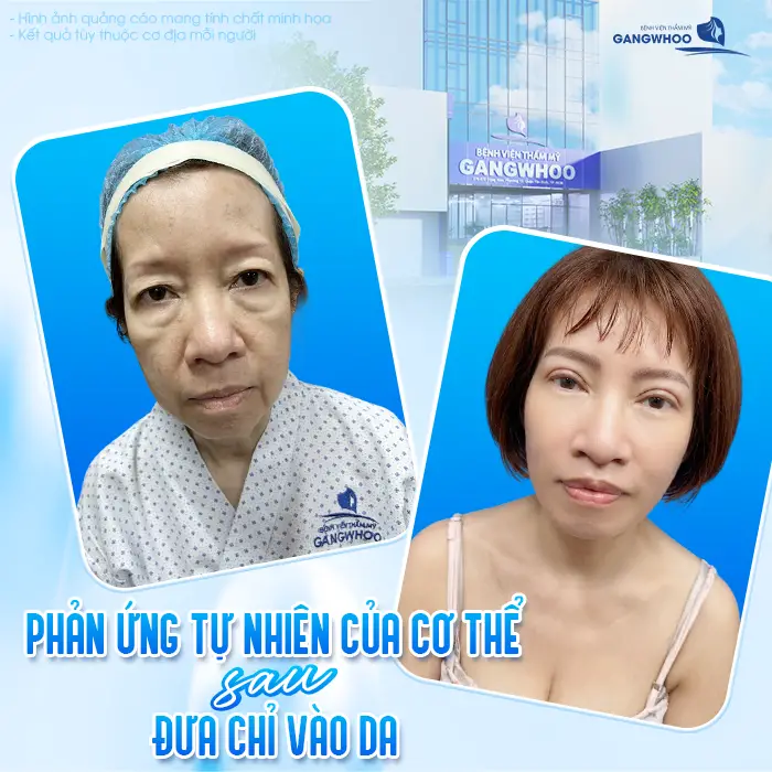 Chỉ Thẩm Mỹ Bị Cộm Ngứa Sau Căng Da Mặt: Nguyên Nhân Và Cách Xử Lý