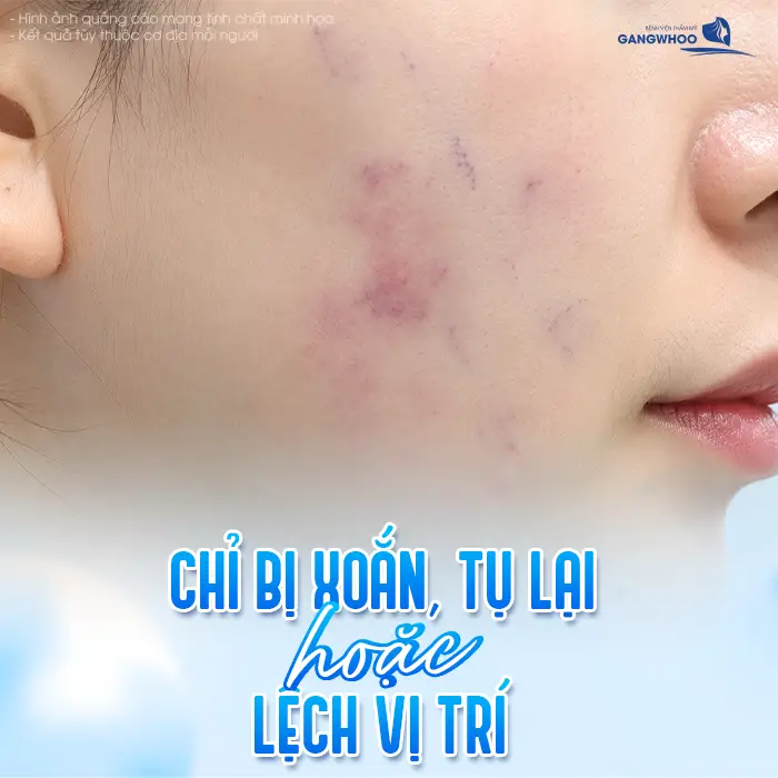 Chỉ Thẩm Mỹ Bị Cộm Ngứa Sau Căng Da Mặt: Nguyên Nhân Và Cách Xử Lý