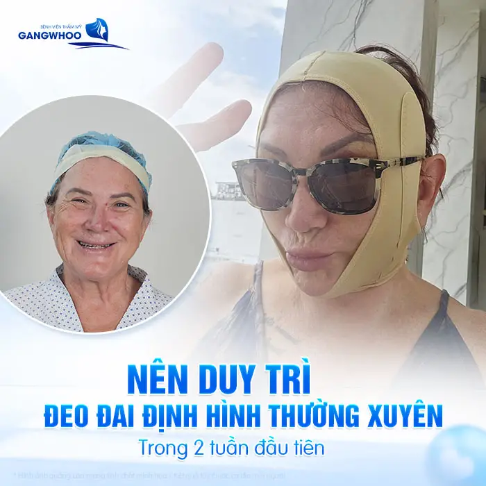 Đeo đai định hình sau căng da mặt giúp hỗ trợ tốt cho quá trình hồi phục mô sau thực hiện