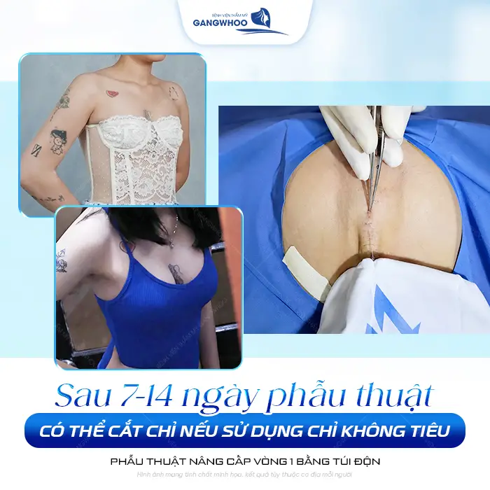 Nâng Ngực Bao Lâu Thì Cắt Chỉ? Timeline Hồi Phục 1 Nâng Ngực Bao Lâu Thì Cắt Chỉ? Timeline Hồi Phục