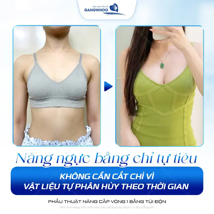 Nâng Ngực Bao Lâu Thì Cắt Chỉ? Timeline Hồi Phục 2 Nâng Ngực Bao Lâu Thì Cắt Chỉ? Timeline Hồi Phục