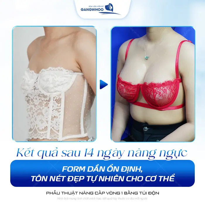 Nâng Ngực Bao Lâu Thì Cắt Chỉ? Timeline Hồi Phục 3 Nâng Ngực Bao Lâu Thì Cắt Chỉ? Timeline Hồi Phục