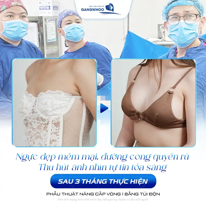 Nâng Ngực Bao Lâu Thì Cắt Chỉ? Timeline Hồi Phục 4 Nâng Ngực Bao Lâu Thì Cắt Chỉ? Timeline Hồi Phục