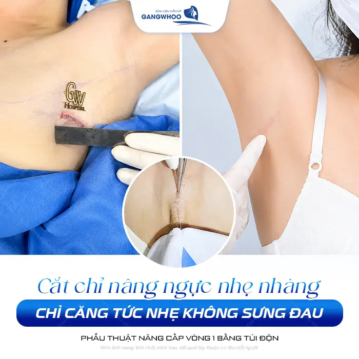 Nâng Ngực Bao Lâu Thì Cắt Chỉ? Timeline Hồi Phục 5 Nâng Ngực Bao Lâu Thì Cắt Chỉ? Timeline Hồi Phục