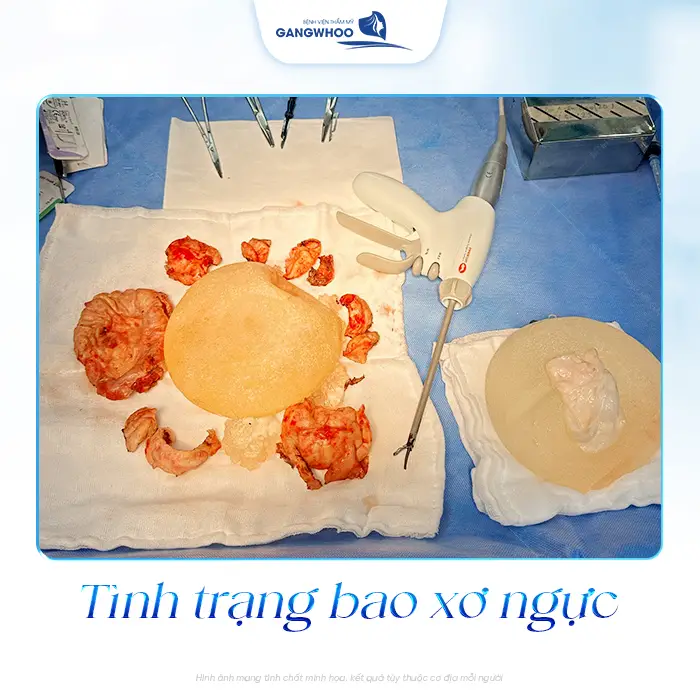 Nâng Ngực Bao Lâu Thì Bị Bao Xơ? Dấu Hiệu Và Cách Phòng Tránh