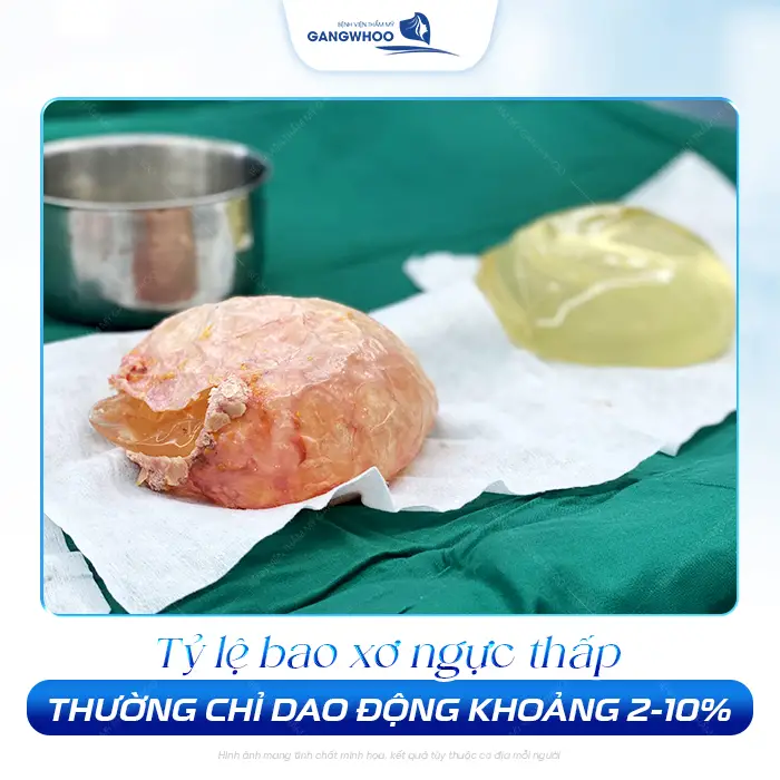 Nâng Ngực Bao Lâu Thì Bị Bao Xơ? Dấu Hiệu Và Cách Phòng Tránh