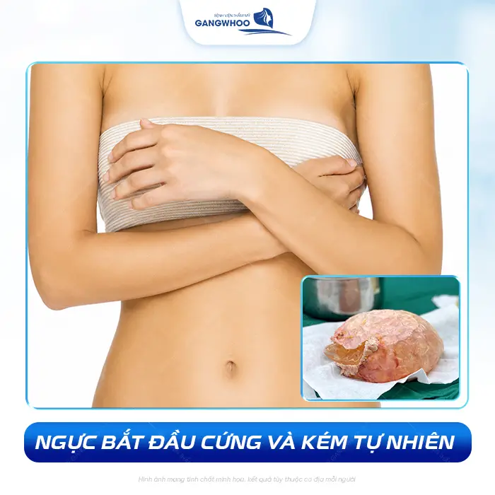 Nâng Ngực Bao Lâu Thì Bị Bao Xơ? Dấu Hiệu Và Cách Phòng Tránh