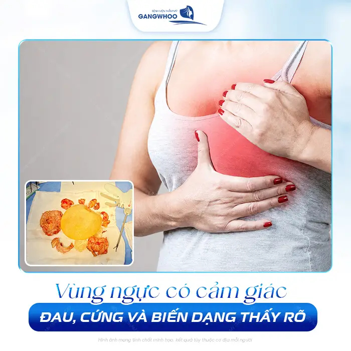Nâng Ngực Bao Lâu Thì Bị Bao Xơ? Dấu Hiệu Và Cách Phòng Tránh