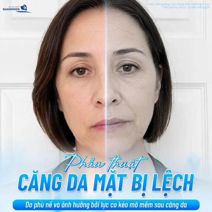 Sau Căng Da Mặt Mặt Lệch Có Sao Không? Nguyên Nhân Và Cách Xử Lý
