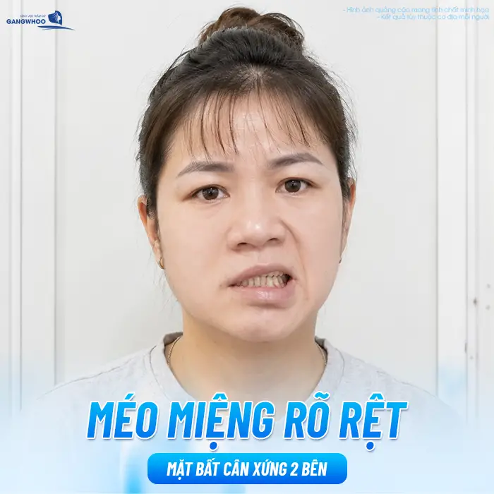 Sau Căng Da Mặt Mặt Lệch Có Sao Không? Nguyên Nhân Và Cách Xử Lý