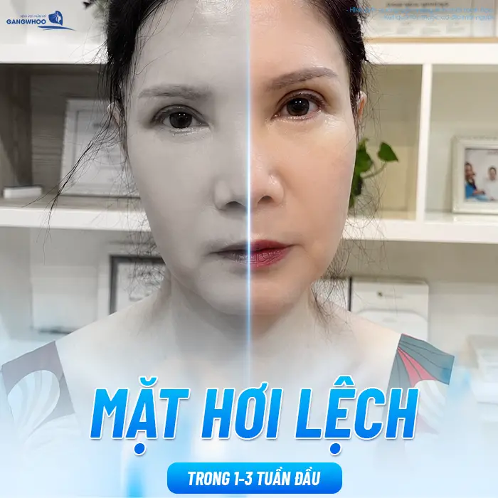 Sau Căng Da Mặt Mặt Lệch Có Sao Không? Nguyên Nhân Và Cách Xử Lý