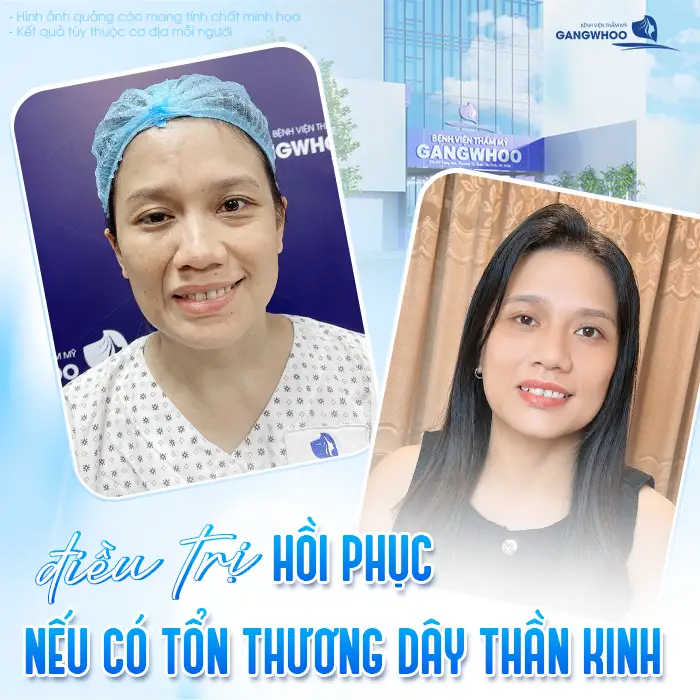 Sau Căng Da Mặt Mặt Lệch Có Sao Không? Nguyên Nhân Và Cách Xử Lý