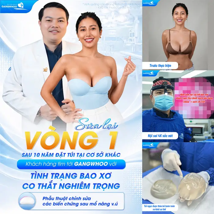 Sửa lại vòng 1 sau 10 năm đặt túi với tình trạng bao xơ co thắt nghiêm trọng