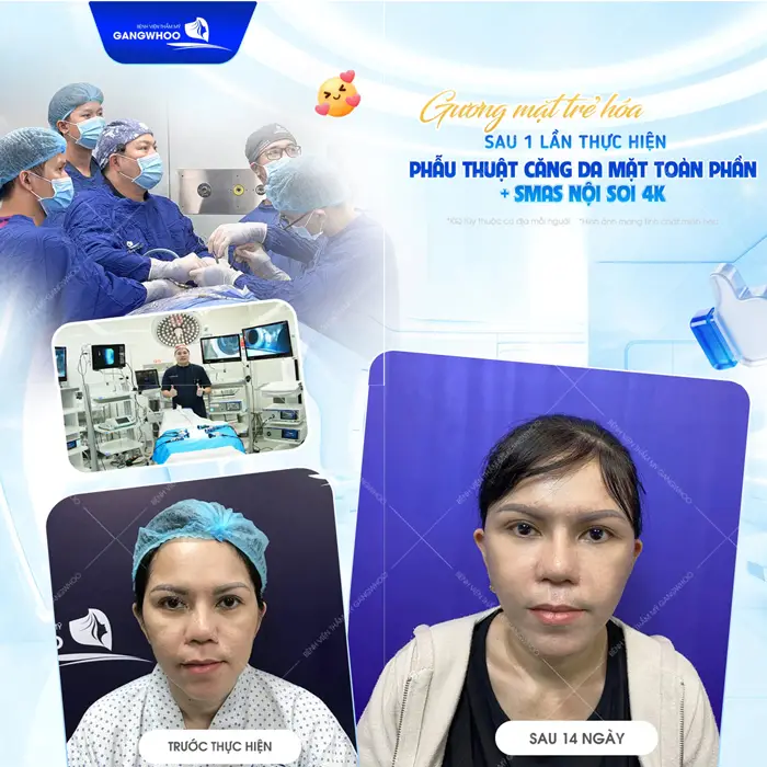 Gương mặt trẻ hơn sau 1 lần căng da mặt toàn phần Smas nội soi 4K