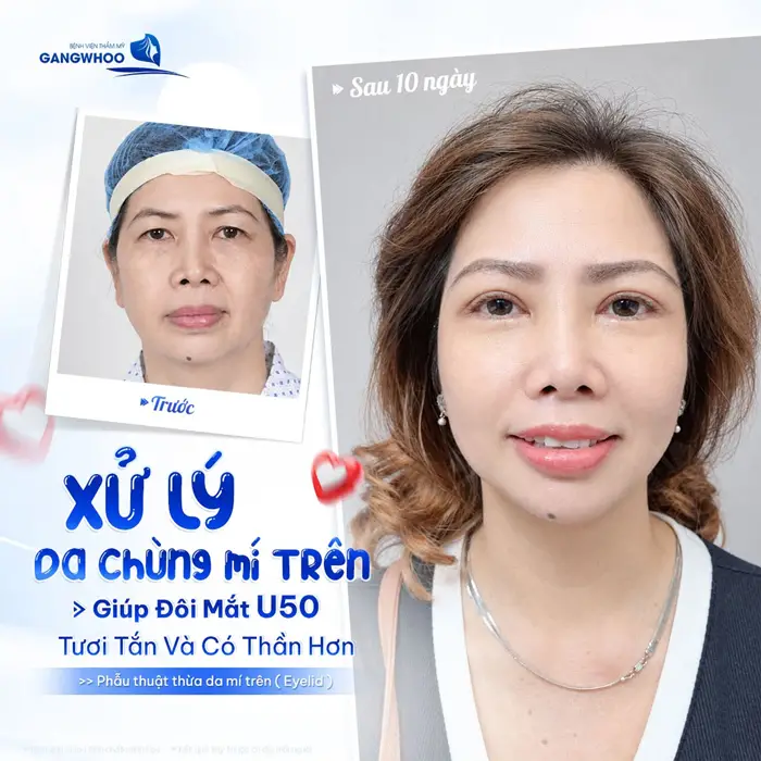 Xử lý da chùng mí trên giúp đôi mắt U50 tươi tắn và có thần hơn sau khi thực hiện