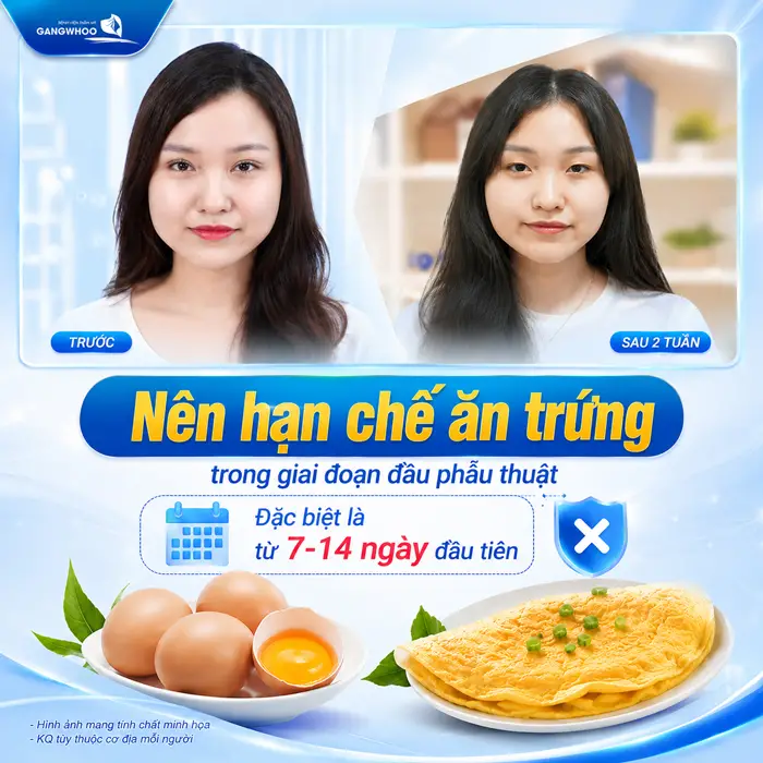 Cắt Mí Mắt Ăn Trứng Được Không? Bác Sĩ Giải Đáp Từ Góc Nhìn Chuyên Môn 3 Cắt Mí Mắt Ăn Trứng Được Không? Bác Sĩ Giải Đáp Từ Góc Nhìn Chuyên Môn