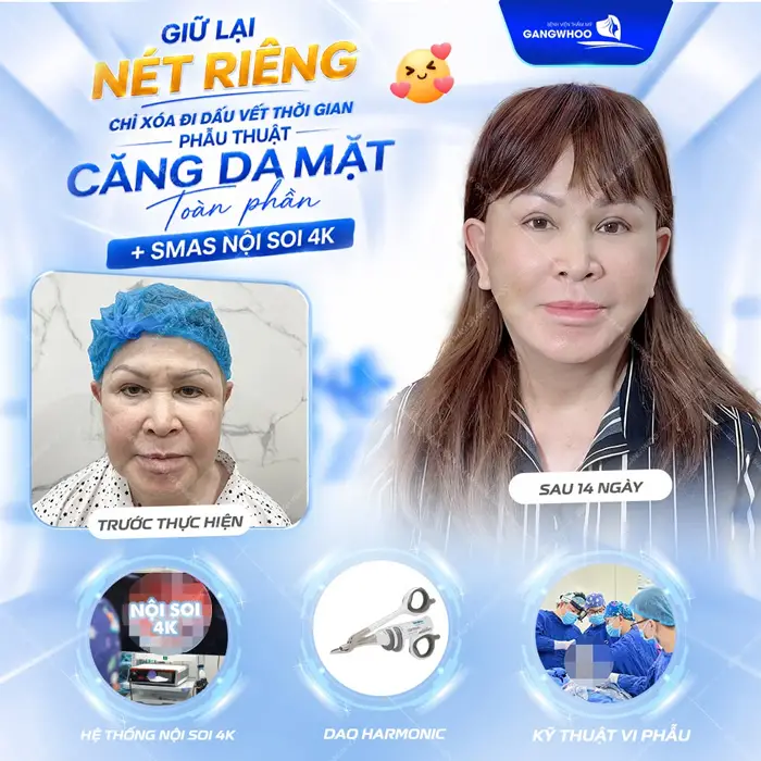 Giữ lại nét riêng chỉ xóa đi dấu vết thời gian sau phẫu thuật căng da mặt toàn phần Smas nội soi 4K