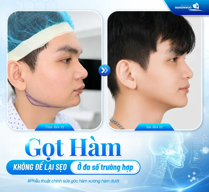 Gọt Hàm Có Để Lại Sẹo Không? Trường Hợp Có Nguy Cơ Để Lại Sẹo