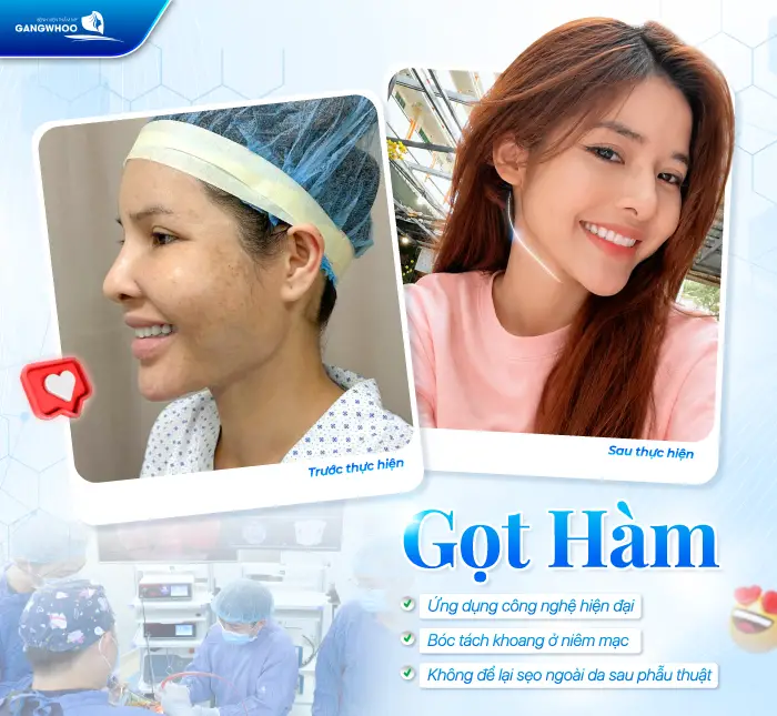 Gọt Hàm Có Để Lại Sẹo Không? Trường Hợp Có Nguy Cơ Để Lại Sẹo