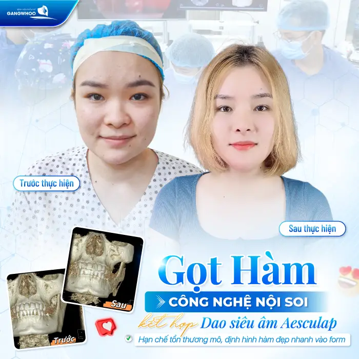 Gọt Hàm Có Để Lại Sẹo Không? Trường Hợp Có Nguy Cơ Để Lại Sẹo
