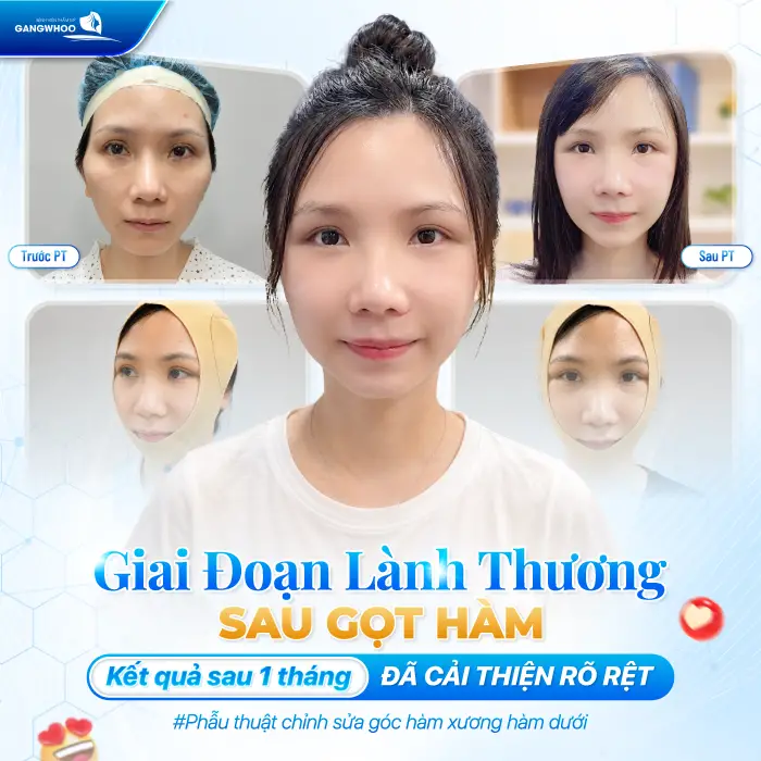 Gọt Hàm Có Để Lại Sẹo Không? Trường Hợp Có Nguy Cơ Để Lại Sẹo