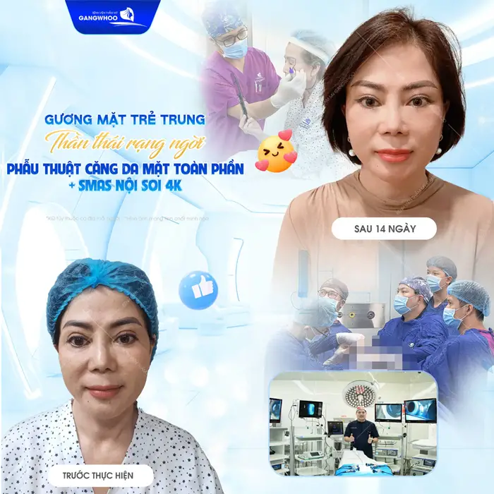 Gương mặt trẻ hơn sau 1 lần căng da mặt toàn phần Smas nội soi 4K