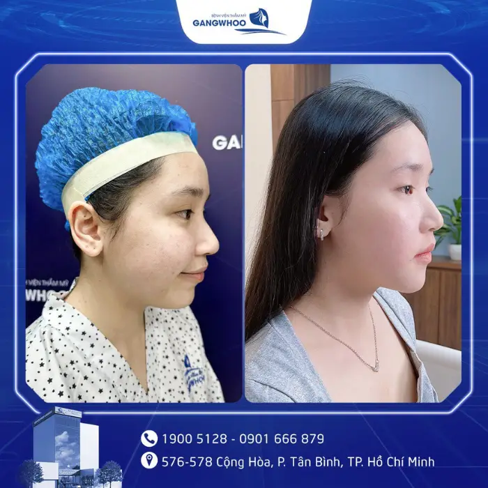 Hạ Gò Má Có Được Vĩnh Viễn Không? Giải Đáp Từ Góc Độ Chuyên Môn 8 ha go ma 4