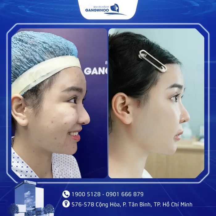 Hạ Gò Má Có Được Vĩnh Viễn Không? Giải Đáp Từ Góc Độ Chuyên Môn 9 ha go ma 5