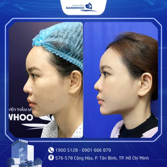 Hạ Gò Má Có Được Vĩnh Viễn Không? Giải Đáp Từ Góc Độ Chuyên Môn 10 ha go ma 6