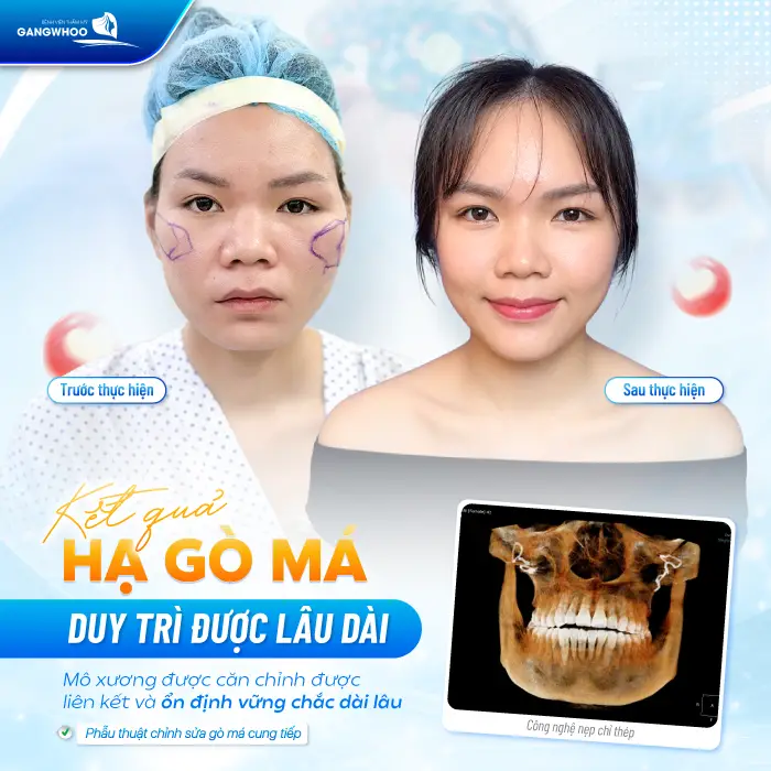 Hạ Gò Má Có Được Vĩnh Viễn Không? Giải Đáp Từ Góc Độ Chuyên Môn 3 Hạ Gò Má Có Được Vĩnh Viễn Không? Giải Đáp Từ Góc Độ Chuyên Môn