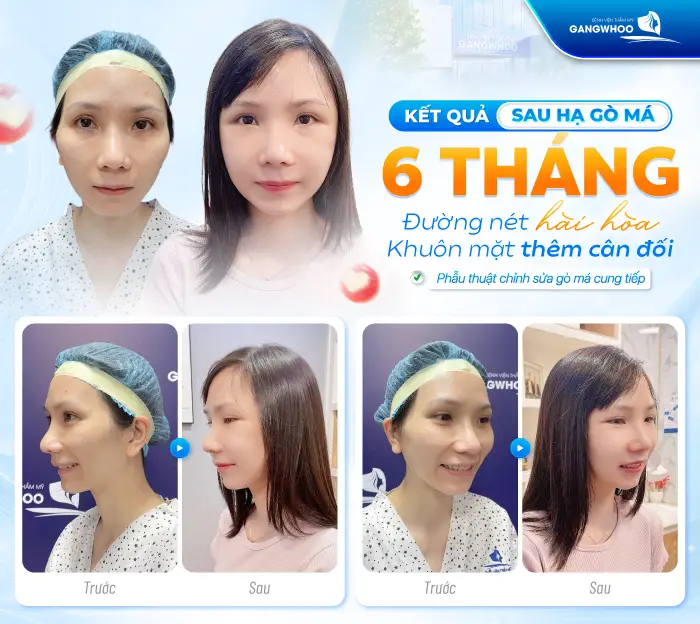 Hạ Gò Má Có Được Vĩnh Viễn Không? Giải Đáp Từ Góc Độ Chuyên Môn 2 Hạ Gò Má Có Được Vĩnh Viễn Không? Giải Đáp Từ Góc Độ Chuyên Môn