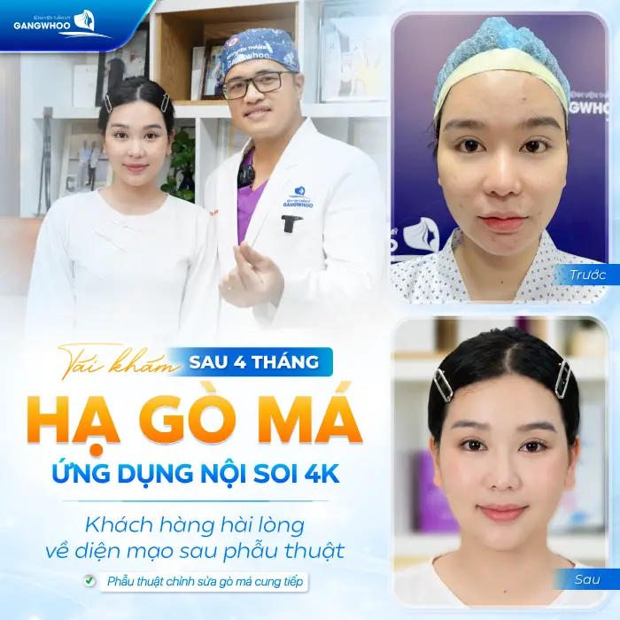 Hạ Gò Má Có Được Vĩnh Viễn Không? Giải Đáp Từ Góc Độ Chuyên Môn 4 Hạ Gò Má Có Được Vĩnh Viễn Không? Giải Đáp Từ Góc Độ Chuyên Môn