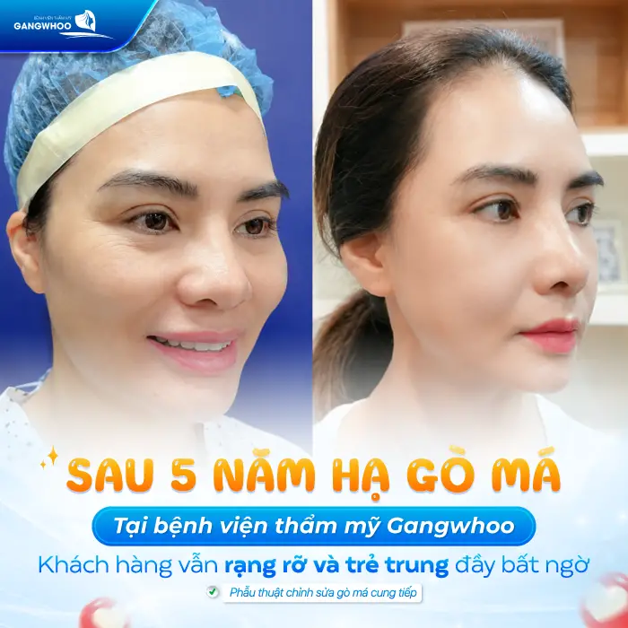 Hạ Gò Má Có Được Vĩnh Viễn Không? Giải Đáp Từ Góc Độ Chuyên Môn 6 Hạ Gò Má Có Được Vĩnh Viễn Không? Giải Đáp Từ Góc Độ Chuyên Môn