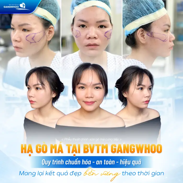 Hạ Gò Má Có Được Vĩnh Viễn Không? Giải Đáp Từ Góc Độ Chuyên Môn 7 Hạ Gò Má Có Được Vĩnh Viễn Không? Giải Đáp Từ Góc Độ Chuyên Môn