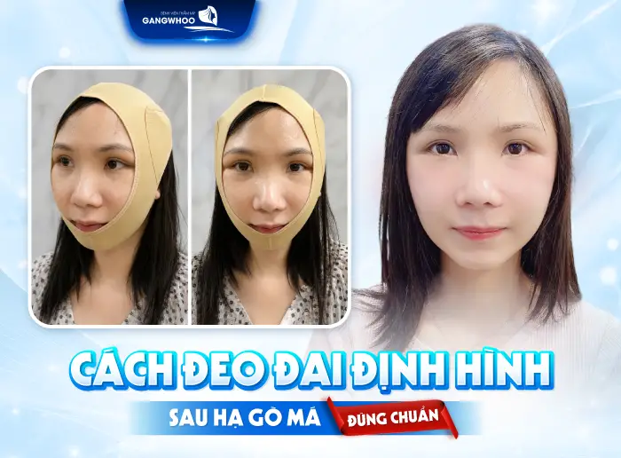 Hạ Gò Má Đeo Đai Định Hình Bao Lâu? Hướng Dẫn Chăm Sóc Đúng Cách