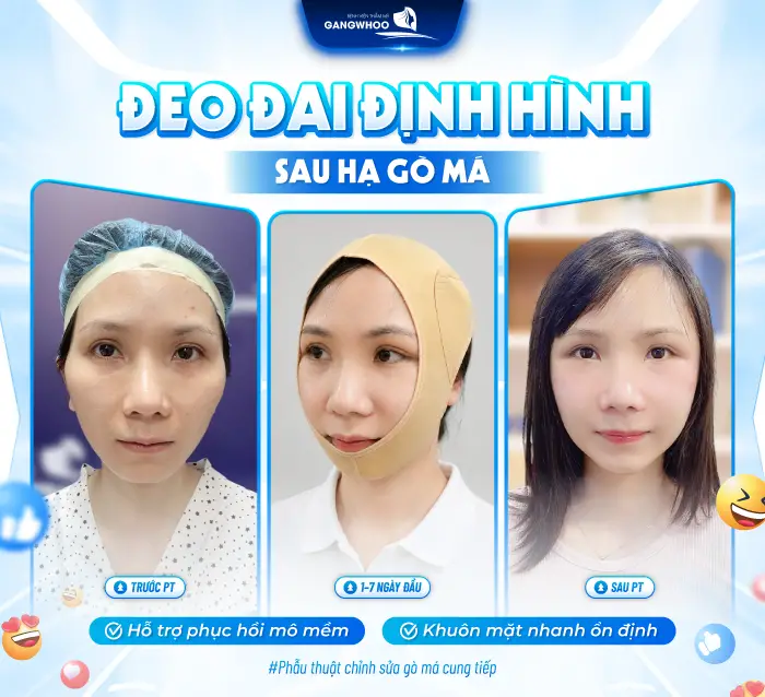Hạ Gò Má Đeo Đai Định Hình Bao Lâu? Hướng Dẫn Chăm Sóc Đúng Cách