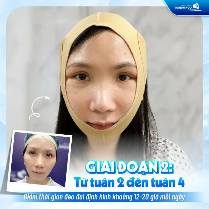 Hạ Gò Má Đeo Đai Định Hình Bao Lâu? Hướng Dẫn Chăm Sóc Đúng Cách
