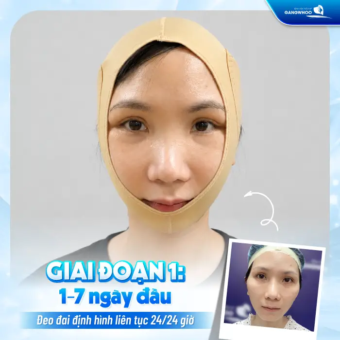 Hạ Gò Má Đeo Đai Định Hình Bao Lâu? Hướng Dẫn Chăm Sóc Đúng Cách
