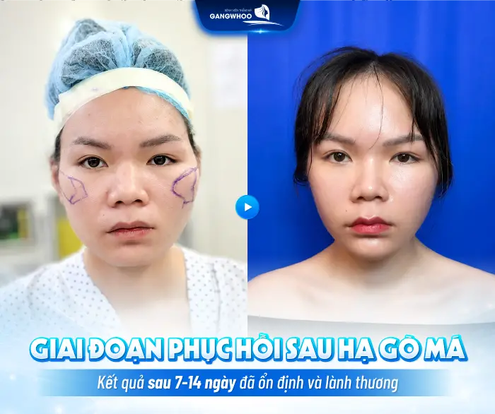 Hạ Gò Má Đeo Đai Định Hình Bao Lâu? Hướng Dẫn Chăm Sóc Đúng Cách