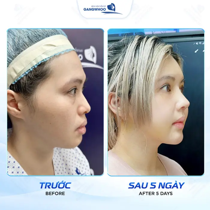 Hạ Gò Má Có Được Vĩnh Viễn Không? Giải Đáp Từ Góc Độ Chuyên Môn 11 ha go ma