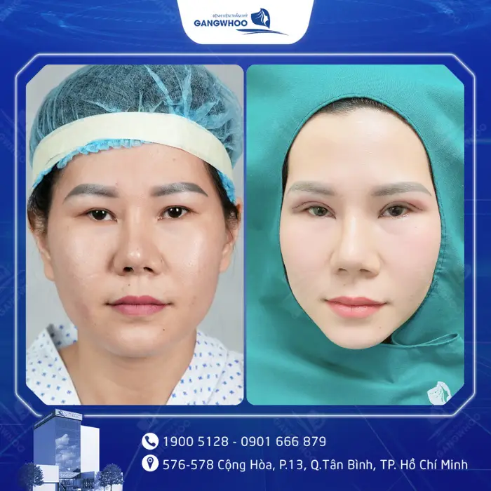 mat hong 1