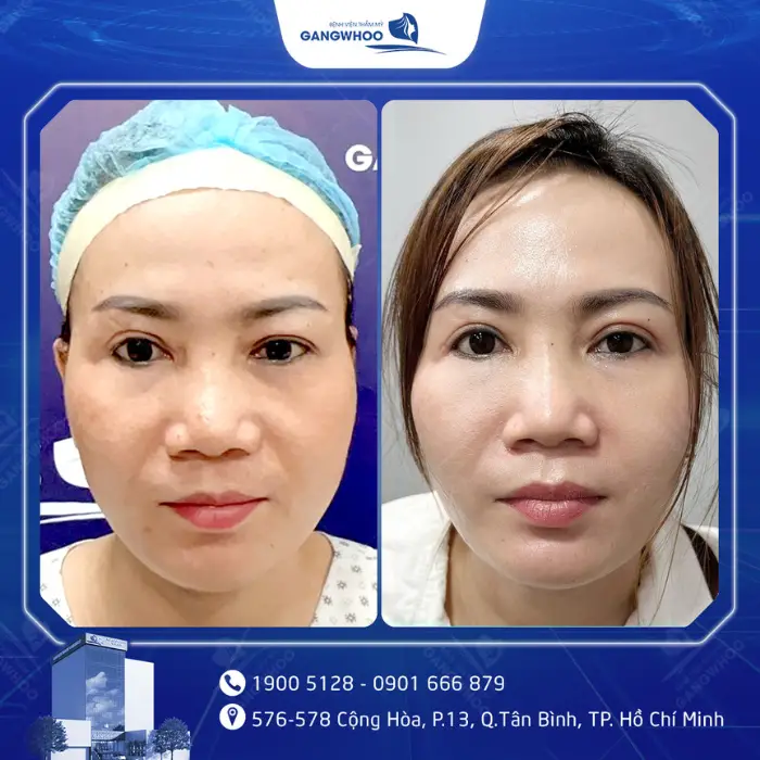 mat hong 5