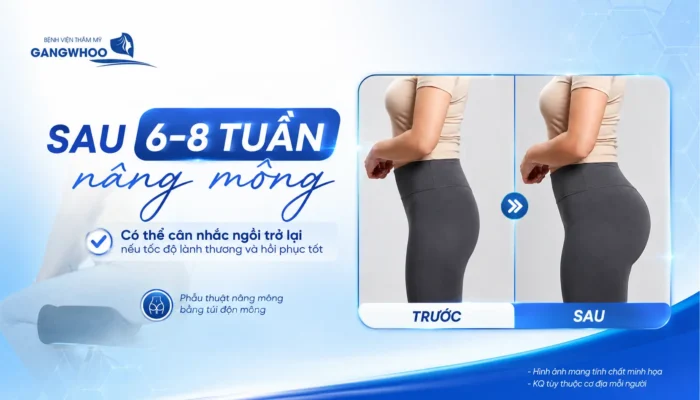 Nâng Mông Bao Lâu Thì Ngồi Được? Thời Gian Hồi Phục Chuẩn Y Khoa